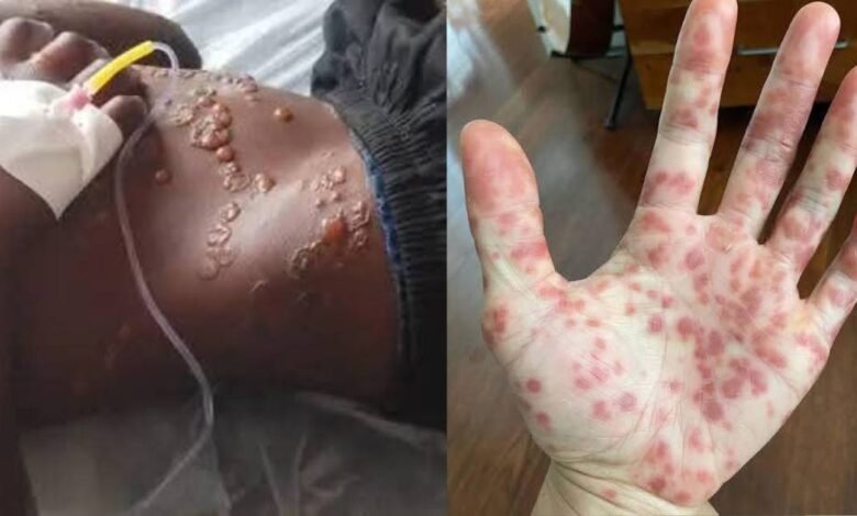 Confirman segundo caso de mpox en Quintana Roo en 2025; contagios siguen a la baja